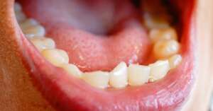 ¿Por qué salen los dientes torcidos o desordenados y cómo corregirlos correctamente? + Caso real Dientes torcidos