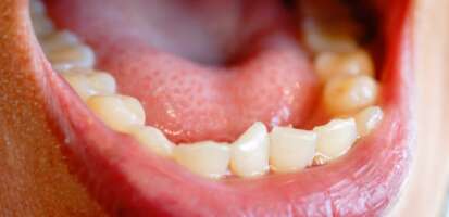 Dientes torcidos