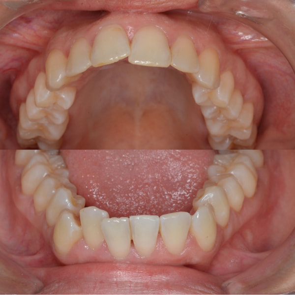 Paciente con dientes torcidos