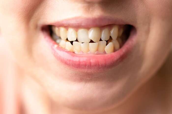 Dientes Torcidos ¿Cómo Corregirlos En Niños Y Adultos?