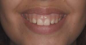 ¿Qué es la sonrisa gingival y cómo se corrige?
