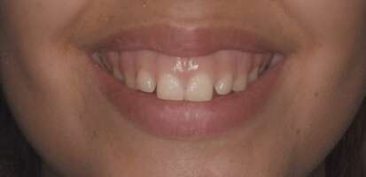 ¿Qué es la sonrisa gingival, cuáles son sus causas y cómo se corrige?
