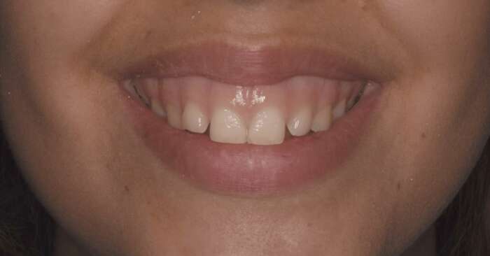 ¿Qué es la sonrisa gingival y cómo se corrige?
