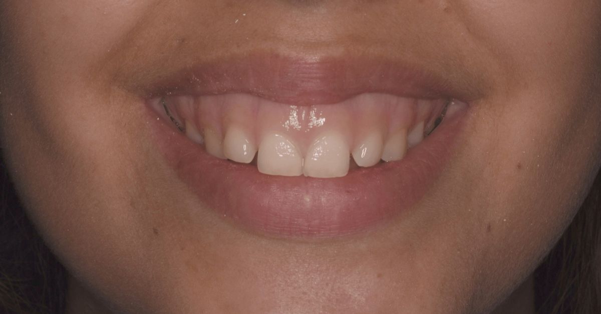 Clínicas Den - ¿Qué es la sonrisa gingival, cuáles son sus causas y cómo se corrige?