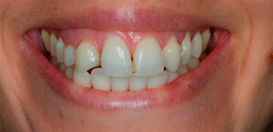 antes blanqueamiento dental