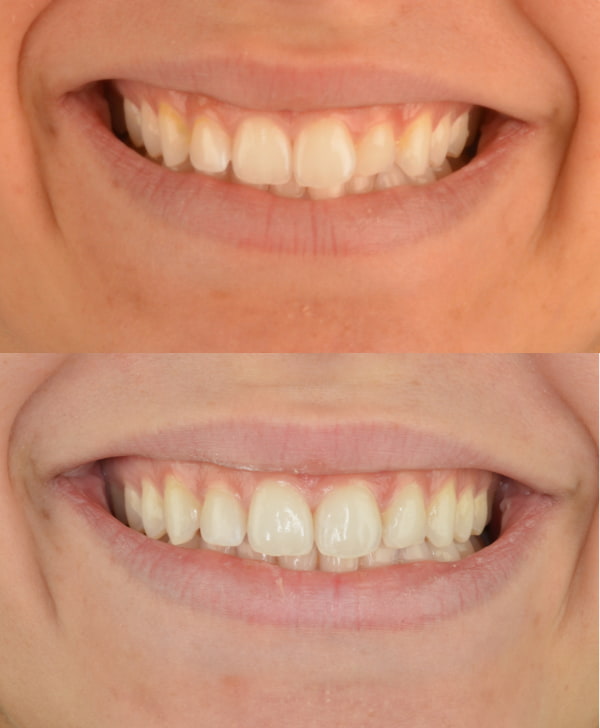 Antes y después de tener recidiva dental