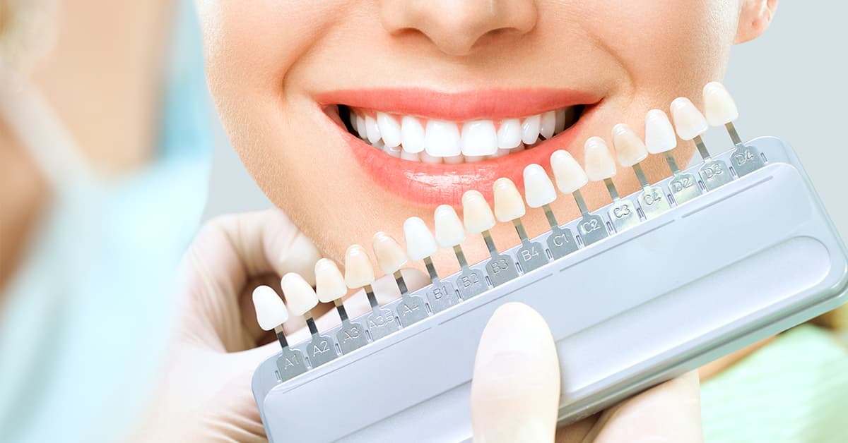Clínicas Den - Blanqueamiento dental antes y después ¡Casos de pacientes de Clínicas Den!