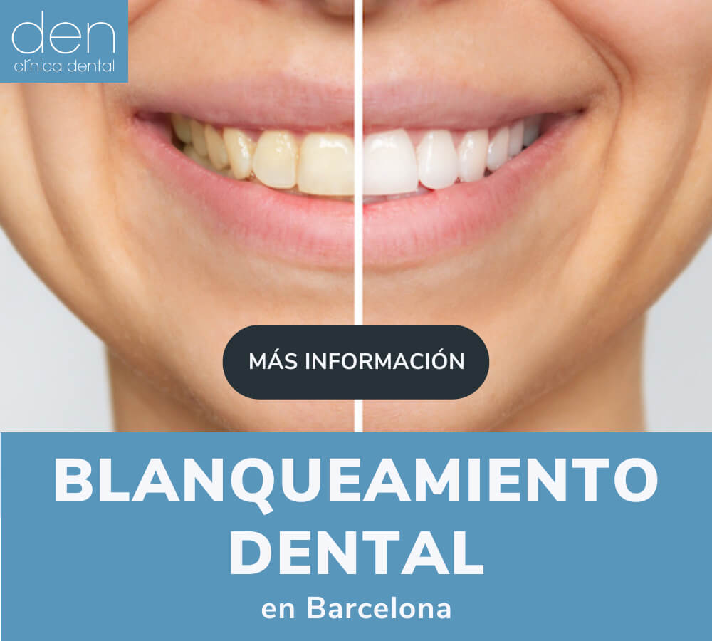 Blanqueamiento dental en Barcelona