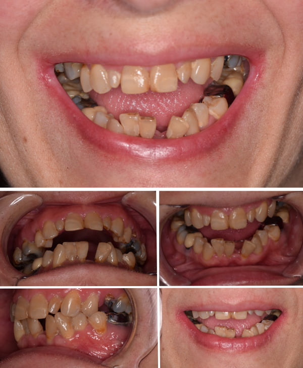 Boca con piorrea, una enfermedad periodontal