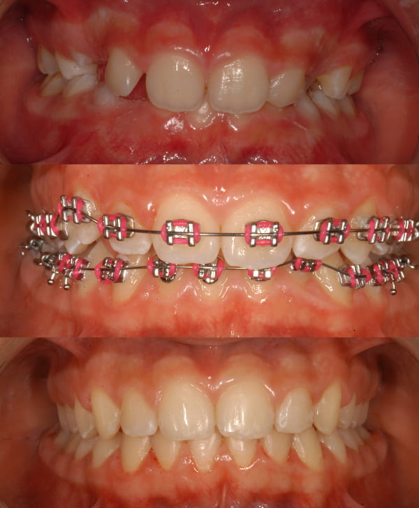 Caso de corrección con brackets infantil