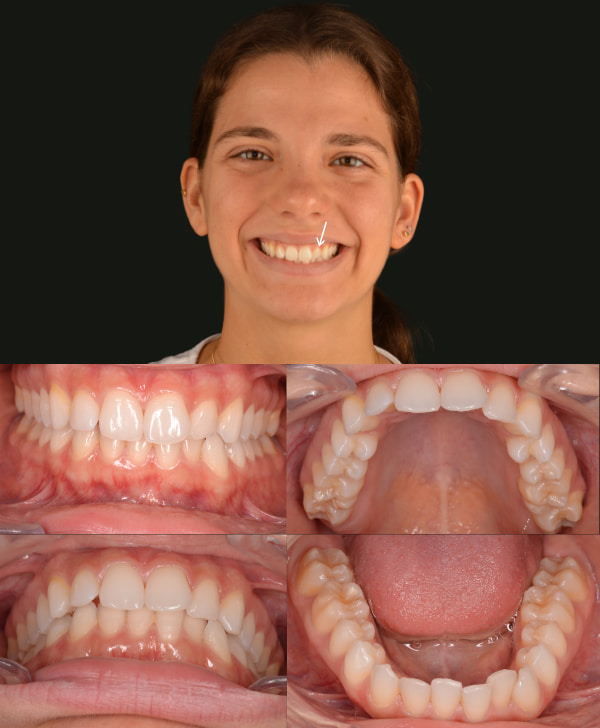 Caso de recidiva dental