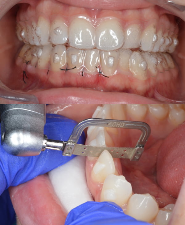 Corticotomías, alineadores invisibles y reducción interproximal