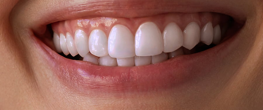 dientes amarillos despues blanqueamiento