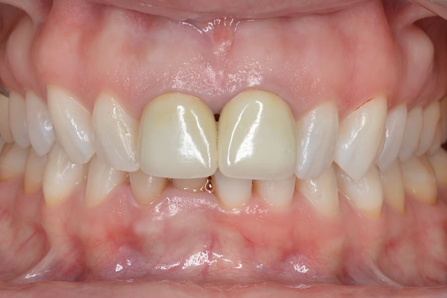 ortodoncia y blanqueamiento dental despues
