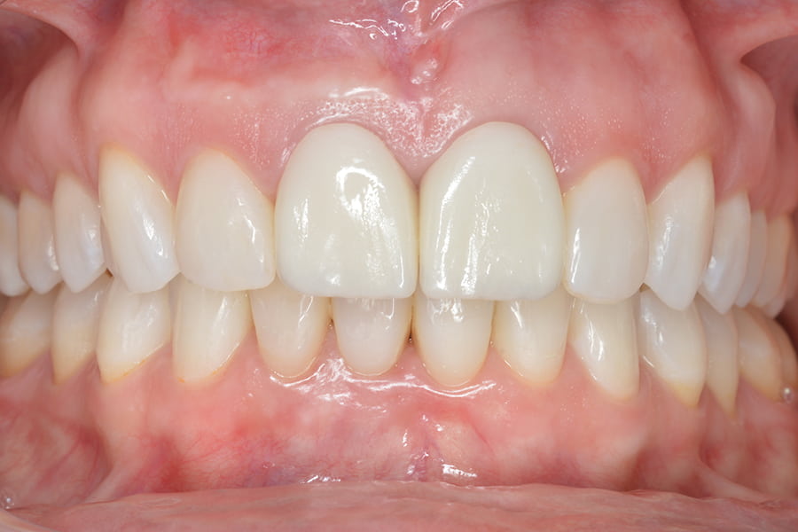 ortodoncia y blanqueamiento dental