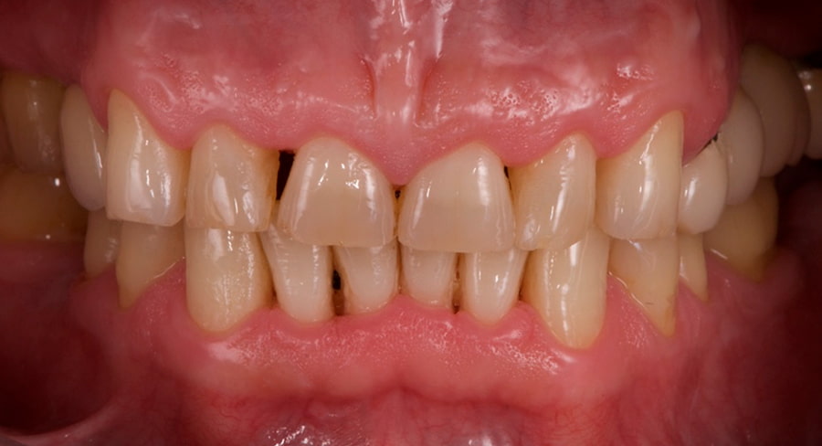Alargamiento dental con carillas