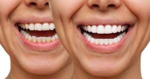 carillas dentales antes y despues