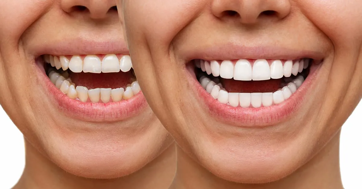 Las coronas dentales. Los dientes en la mandíbula superior, las