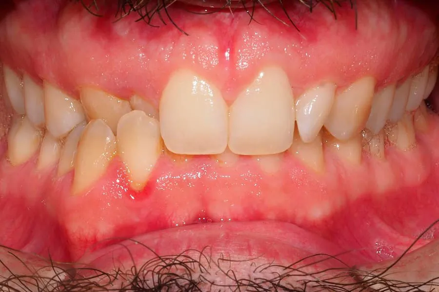 Carillas dentales antes y despues: 6 casos reales
