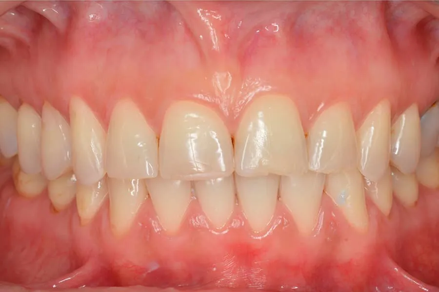 Carillas dentales y famosos. Antes y después. - Uniclinic
