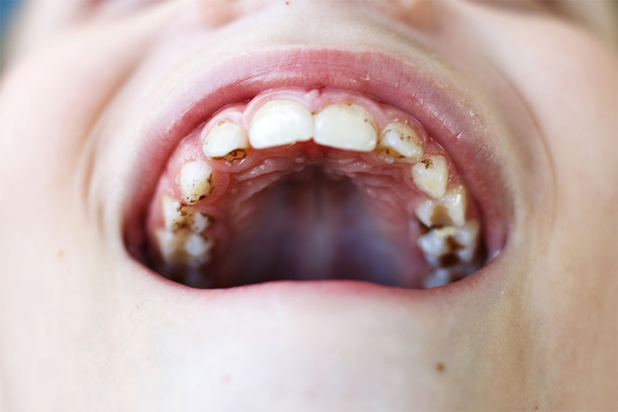 Manchas negras en los dientes causas