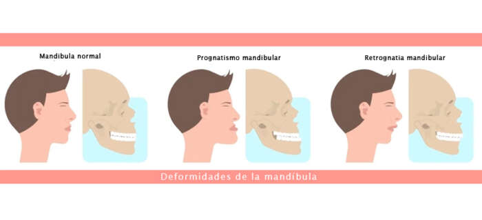 Retrognatia Mandibular o Clase II ¿Qué es y cómo se trata?