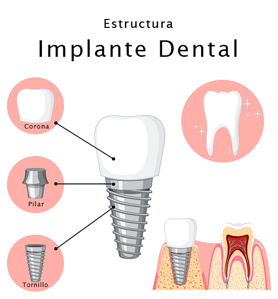 Qué es la implantología dental