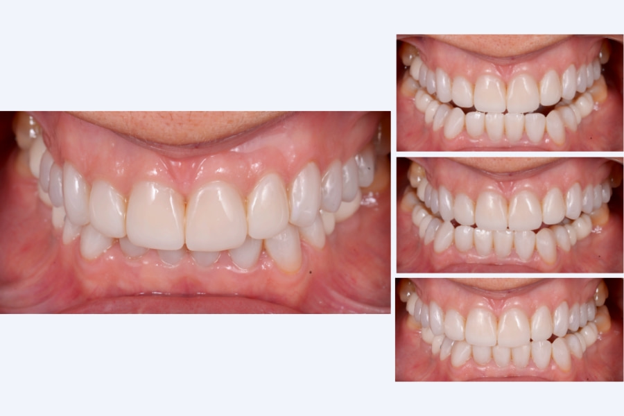 Caso de rehabilitación oral completa