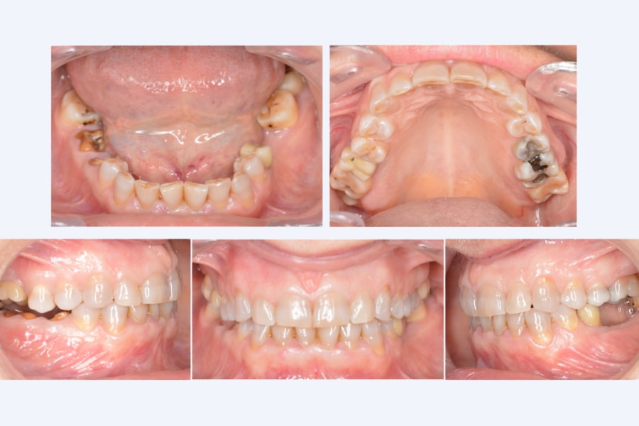 Caso de desgaste, pérdida dental y dolor articular