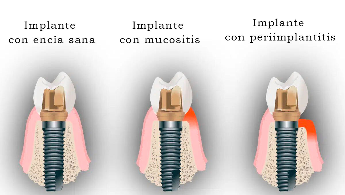 Diferencia entre mucositis periimplantaria e implante dental sano