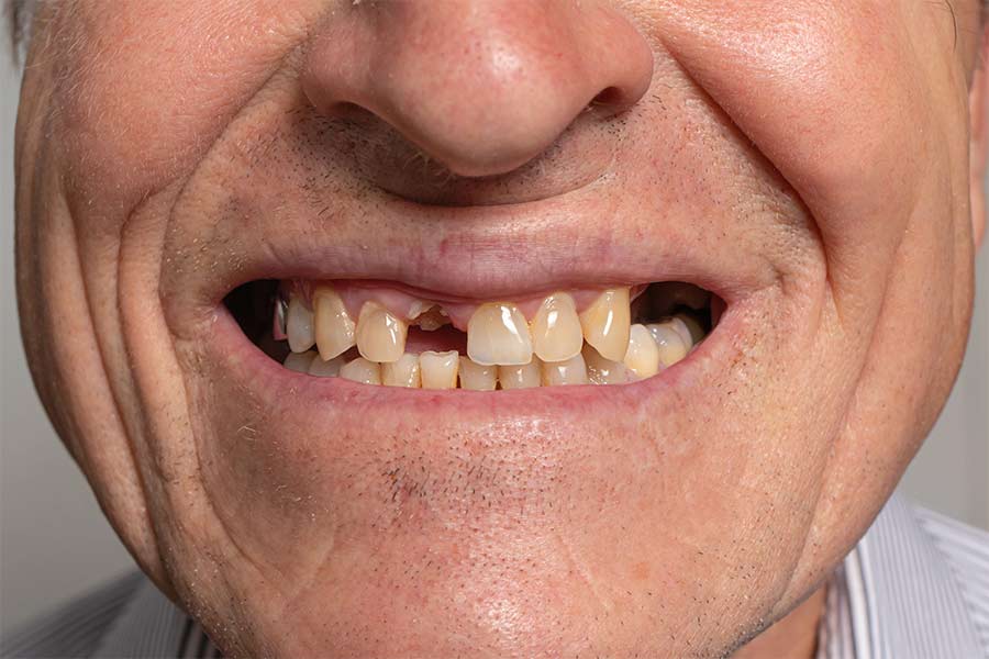 Se puede hacer un implante dental sin hueso