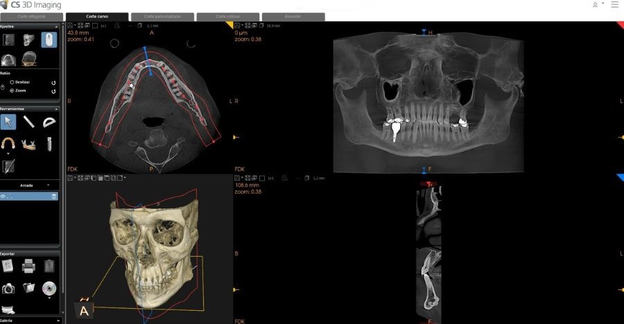 Tecnología CBCT para realizar diagnóstico de bruxismo 