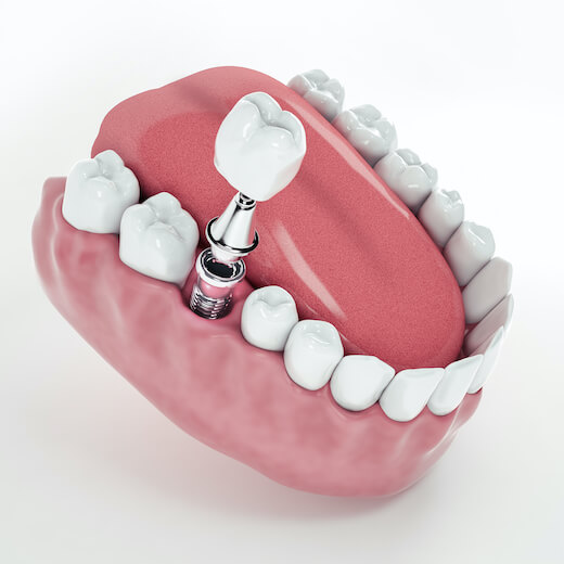 Implantes Dentales en Barcelona