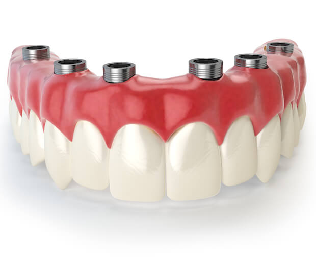 Prótesis dental en 3D