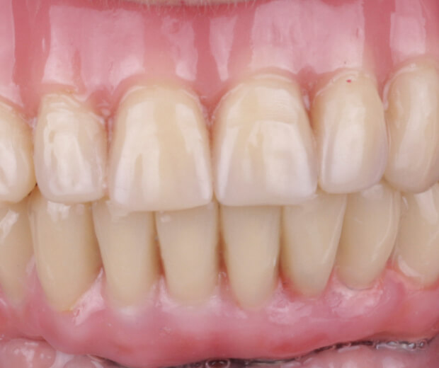Prótesis dental fija sobre implantes