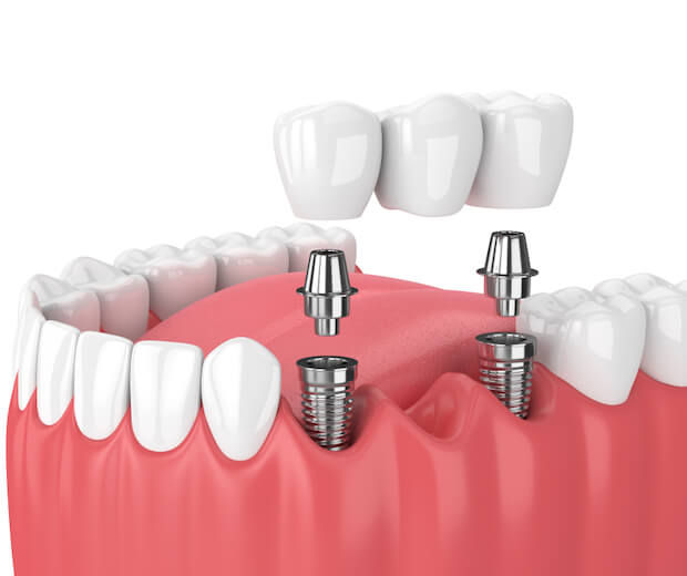 Puentes Dentales sobre implantes