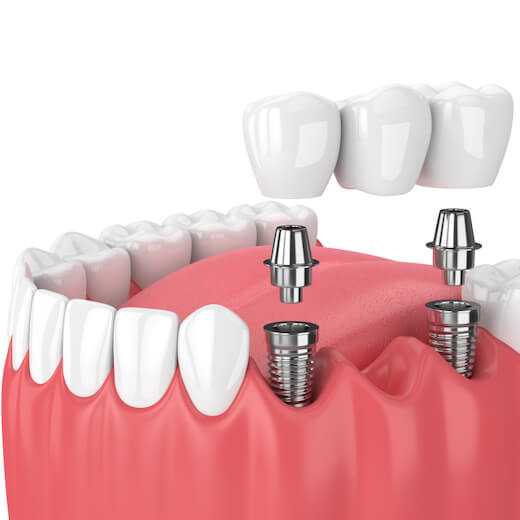 Puentes dentales sobre implantes