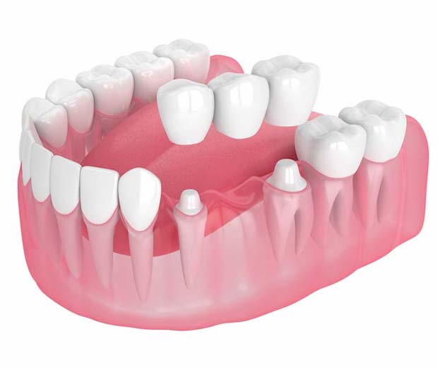 Puentes Dentales sobre dientes