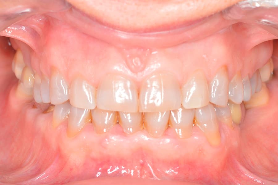 Antes desgaste de dientes posteriores