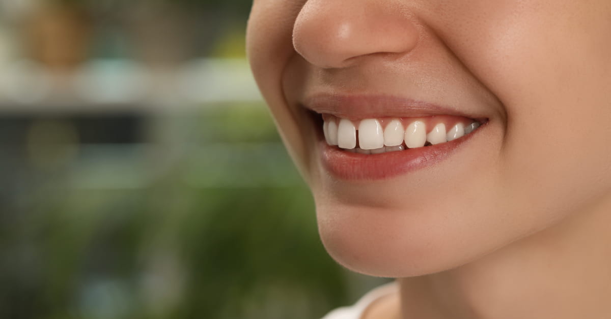 Clínicas Den - ¿Qué es el diastema, cuáles son sus causas y tratamientos para corregirlo? Clínicas Den - ¿Qué es el diastema, cuáles son sus causas y tratamientos para corregirlo?