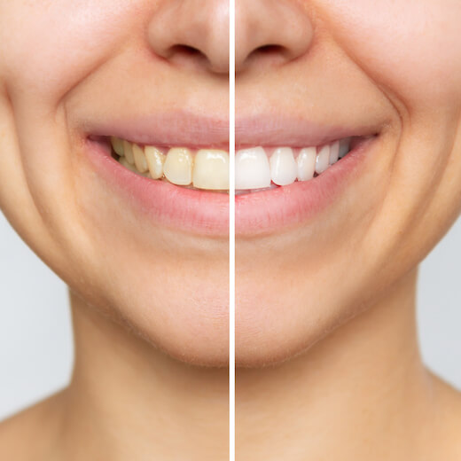 Blanqueo dental, antes y después