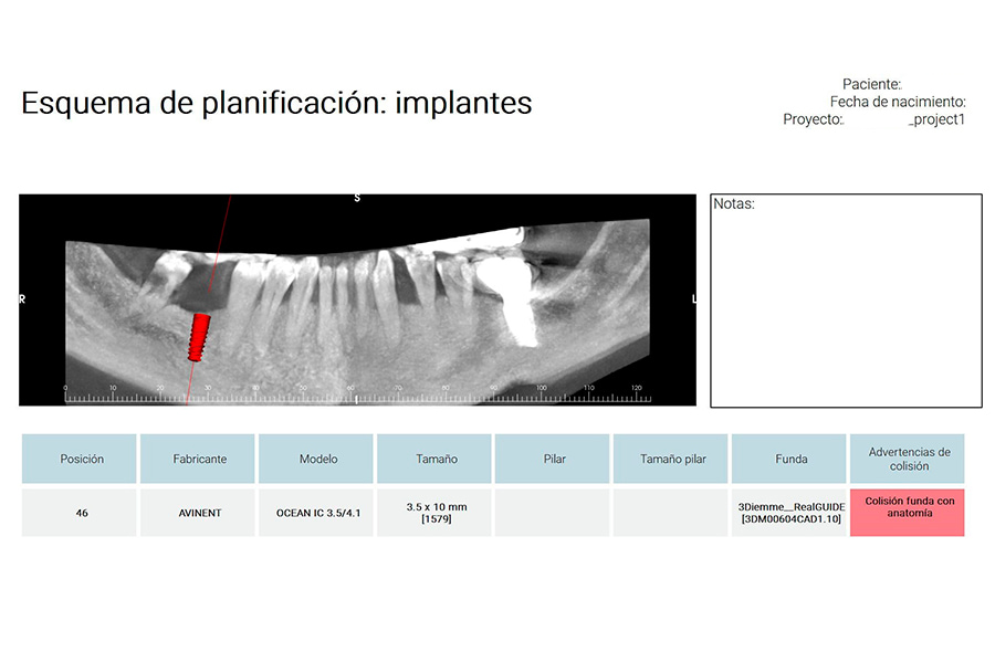 Planificación de implantes dentales