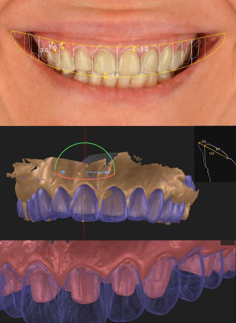 Estudio personalizado para puente dental