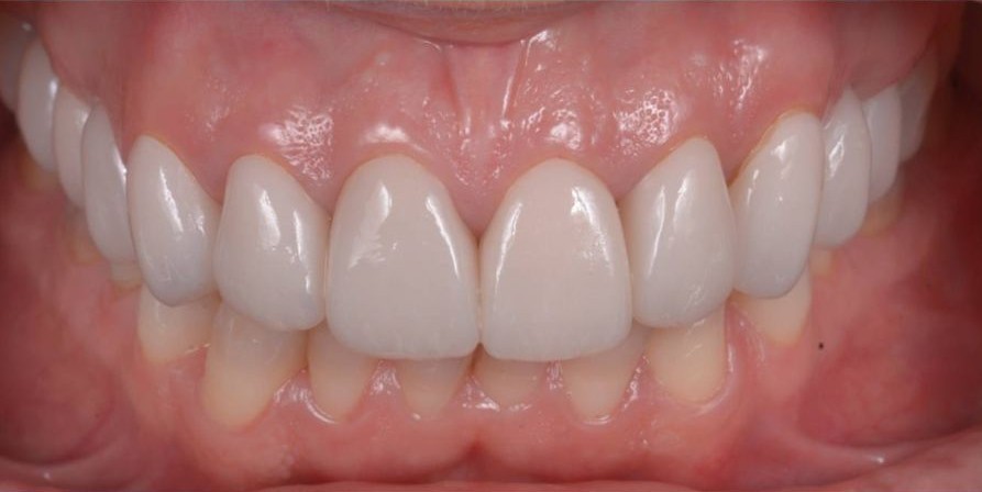 Paciente con puente dental después