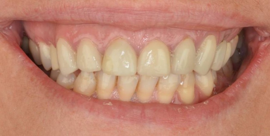 Paciente que requiere un puente dental