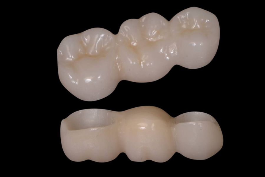 Puente parcial sobre dientes de zirconio monolítico dientes zirconio