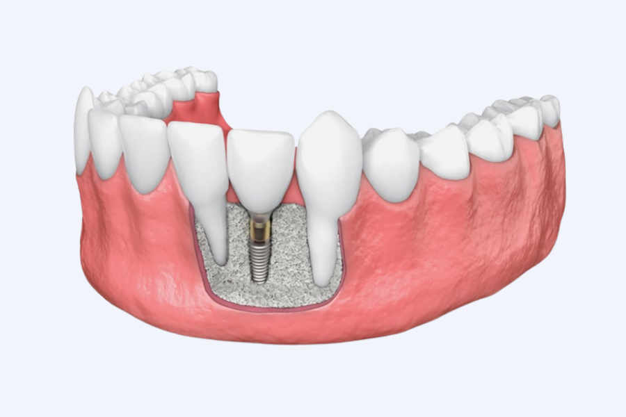 Qué es la regeneración ósea dental