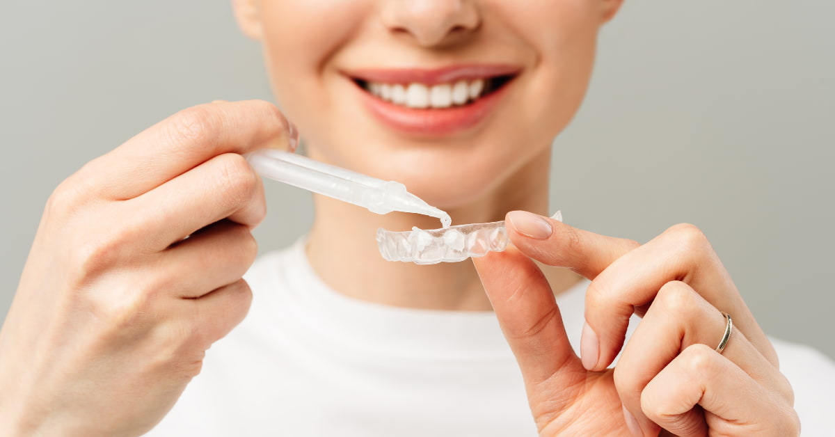 Clínicas Den - ¿Cómo funciona un blanqueamiento dental en casa con férulas? ¿Cuándo es más seguro y eficaz? Clínicas Den - ¿Cómo funciona un blanqueamiento dental en casa con férulas? ¿Cuándo es más seguro y eficaz?