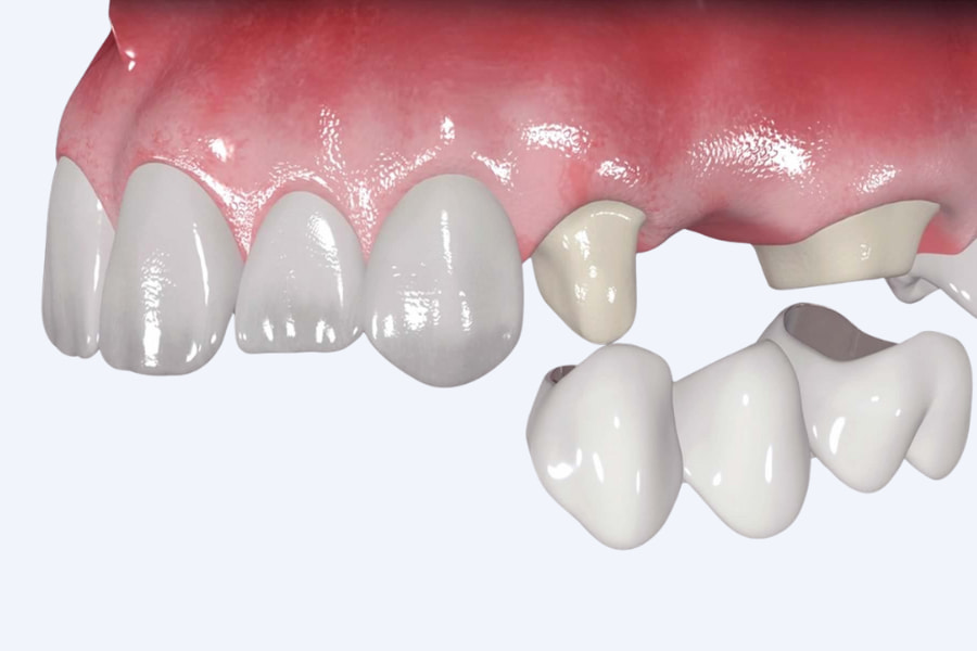 Qué son las prótesis fijas sobre dientes naturales