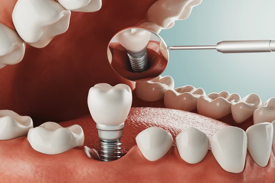 Beneficios implantes dentales